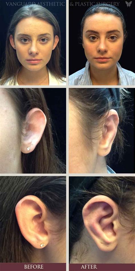 Ear Reconstruction Surgery In Ft Lauderdale Fl Vanguard Aesthetic