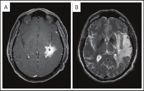 3 Tesla Mri Imaging Of The Brain A Axial Fat Saturated Postcontrast