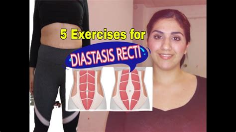 5 DIASTASIS RECTI EXERCISES How To Close The Gap In Your Stomach YouTube