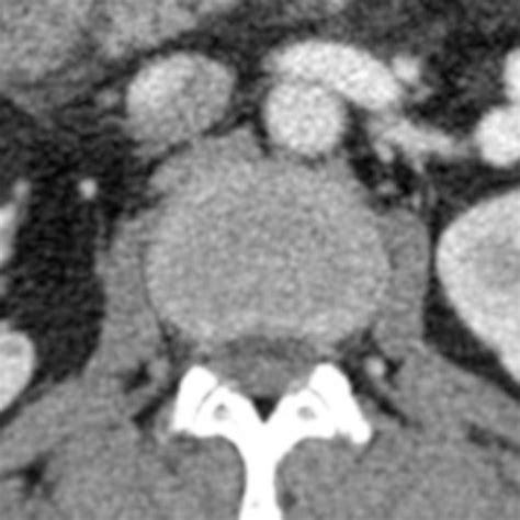 Axial Contrast Enhanced Ct Shows Spleno Renal Shunt Red Arrow