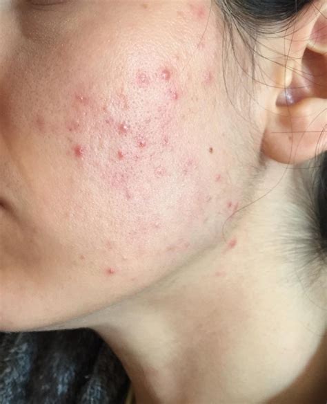 Skin Concerns Need Help With Stubborn Cheek Acne Rskincareaddiction
