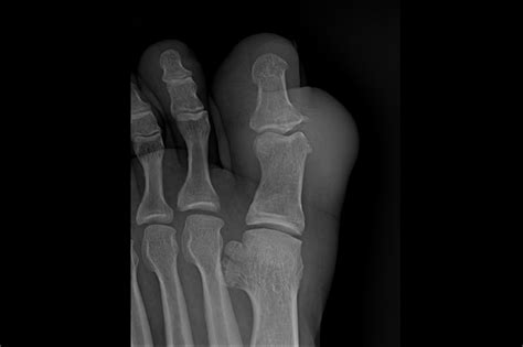 Ortho Dx Pain And Swelling In The First Toe Clinical Advisor
