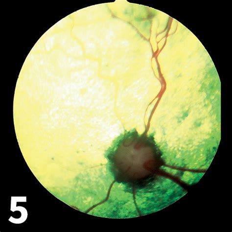 Untreated retinal detachment results in loss of a portion of the visual field. Retinal Detachment | Clinician's Brief