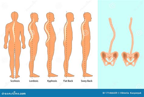 Vector Illustration Of Spinal Deformity Types Scoliosis Lordosis And