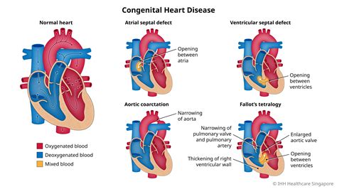 Congenital Heart Disease Chd Symptoms And Causes Mount Elizabeth