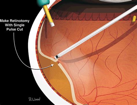 Vitrectomy Retinal Detachment