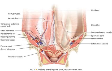 A direct inguinal hernia (alternative plural: Inguinal Hernia: Laparoscopic Approaches | Basicmedical Key