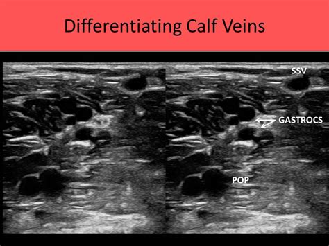 Right Peroneal Vein