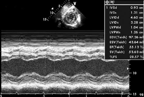 M Mode Transthoracic Echocardiography In Parasternal Short Axis View 12