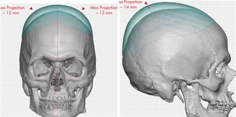 Custom Skull Implant Design Measurements Dr Barry Eppley Indianapolis