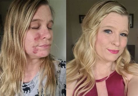 Cystic Acne Left Woman Too Self Conscious To Leave The House What Is