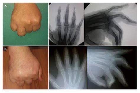 Isolated Dorsal Approach For The Treatment Of Neglected Volar Metacarpophalangeal Joint Dislocations