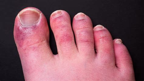 Covid Toes Could Last For 150 Days New Research Finds Nbc New York