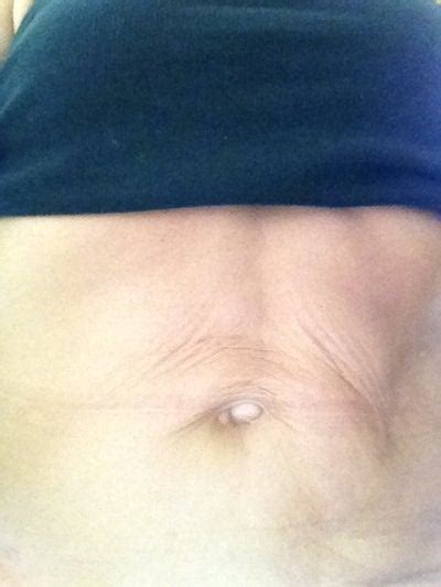 Is There A Way To Remove Excess Skin Above The Belly Button Using