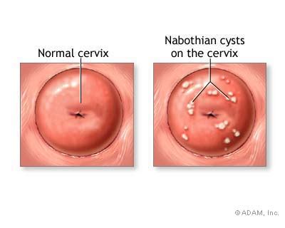The New York Times Health Image Nabothian Cyst