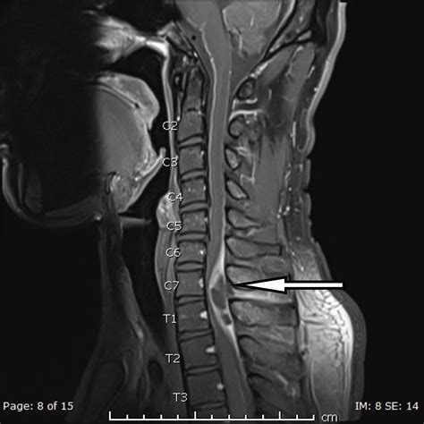 Cureus A Case Of Spinal Epidural Abscess Presenting With Horner Syndrome