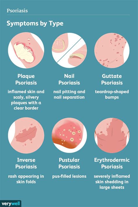 Psoriasis Symptoms And Complications Psoriasis Symptoms Pustular