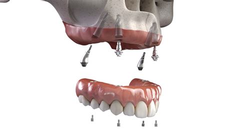 All-on-X Dental Implants - Beaumont Dental Center
