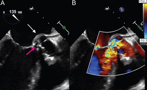 Imaging To Evaluate Suspected Infective Endocarditis Cleveland Clinic