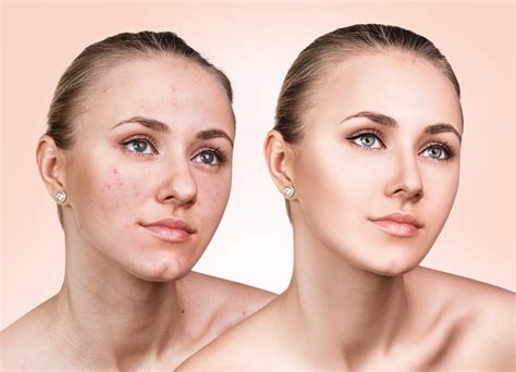 The Skin Before And After Acne Removal By The Experts