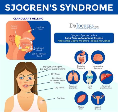 Best Diet For Sjogrens Syndrome Sfdesignlist