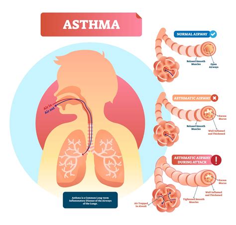 Ppt Asthma Diagnosis Anatomy And Pathophysiology Of Asthma Gambaran