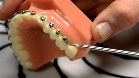 Cut the scissors into sandpaper a few times, turn the scissors over, and cut a few more times. Wax: A Great Temporary Fix for Braces with Poking Wire ...