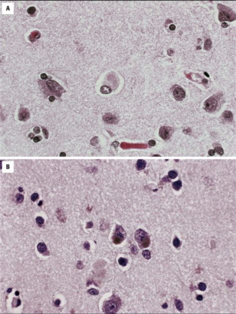 In this twenty minute video professor ian mckeith gives an in depth description of dementia with lewy bodies: Neuropathology and Braak Staging of Parkinson's Disease ...