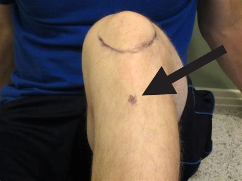 Q And A My Top 5 Tips On How To Self Treat Osgood Schlatter Disease
