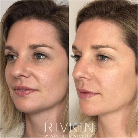 Nasolabial Folds Rivkin Aesthetics