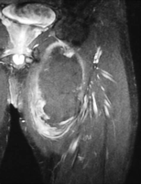 Mri Features In The Differentiation Of Malignant Peripheral Nerve