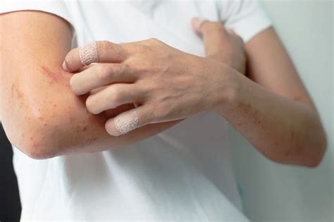 Thyroid And Hives Relationship - Thyroid Advisor