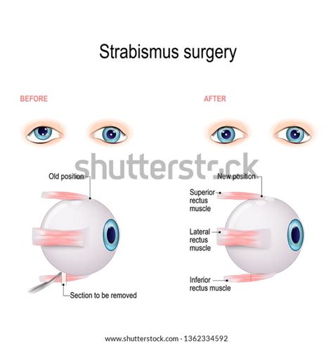 Strabismus Surgery Hypertropia Eye Muscle Recession Stock Illustration