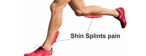Physio For Shin Splints Physiotherapy Treatment For Shin Splints