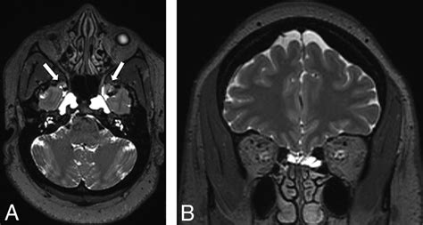 Detection And Characteristics Of Temporal Encephaloceles In Patients