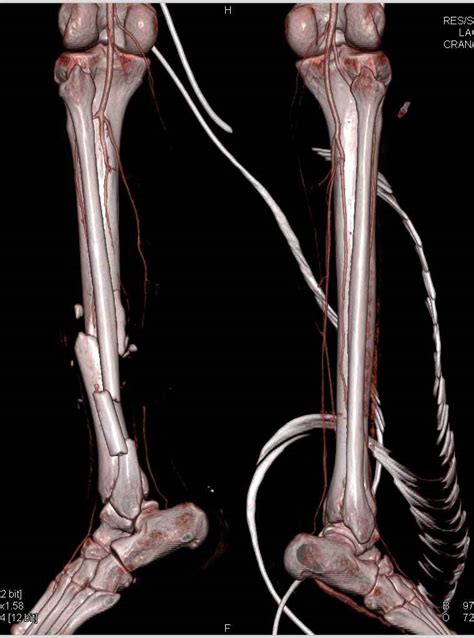 Comminuted Fracture Of Left Tibia And Fibula With Vascular Occlusion