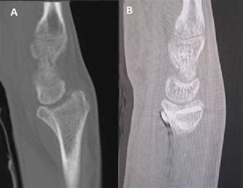 The Malunion Of Distal Radius Fracture Corrective Osteotomy Through