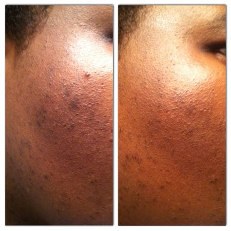 The Magic Of Black Soap Before And After After 30 Days