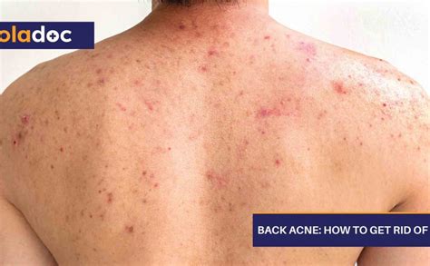 Back Acne How To Get Rid Of It Beauty And Skin Care