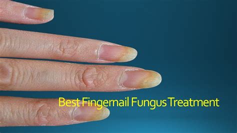 Medicine For Nail Fungus News And Health