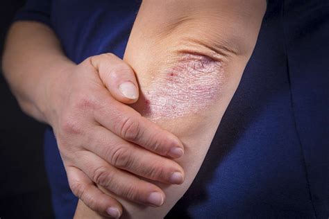 Elbow Psoriasis Symptoms Diagnosis And Treatment