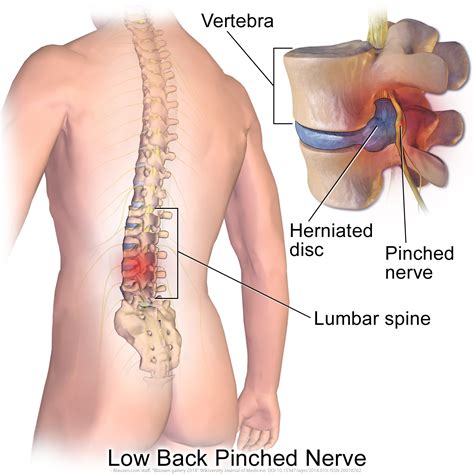 Pinched Nerve Back And Neck Pain Relief