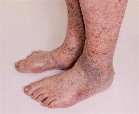 Stages Of Vein Disease When To Take Action Stridecare