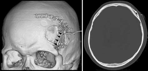 Chronic Headache Caused By A Titanium Fixation Plate Report Of Two