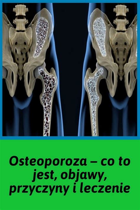 Osteoporoza Objawy Przyczyny I Leczenie Choroby Ko Ci Hot Sex Picture