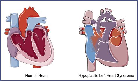 Hypoplastic Left Heart Syndrome From Bedside To Bench And Back