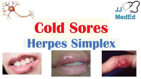 Cold Sores Oral Herpes Causes Signs And Symptoms Treatment Youtube