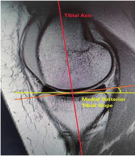 Mri Picture Depicting Calculation Of Medial Posterior Tibial Slopempts