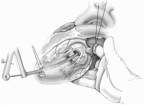 Surgery of the Mitral Valve | Thoracic Key