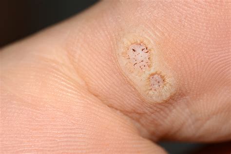 Closeup Of Two Plantar Warts On A Toe Caused By The Human